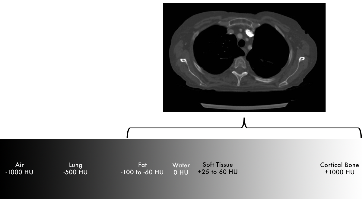 Hounsfield Units Bone Window